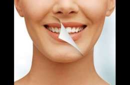Estetik Laminate veneer diş nedir?Porselen Lamina diş kaplama avantajları nelerdir?