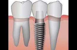 İmplant diş nasıl uzun ömrlü olabilir? En iyi implant markaları İstanbul Türkiye