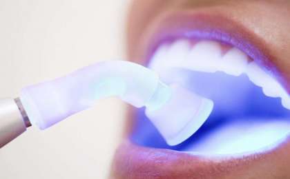 Diş beyazlatma işlemi yapılışı nasıldır?