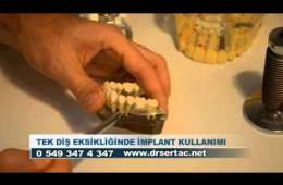 Diş eksikliğinde implant ve kaplama diş karşılaştırılması. İmplant diş avantajları İstanbul Türkiye