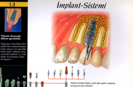 İmplant diş yapımı ile ilgili bilgiler bulabileceğiniz bu sunumda görseller ile genel bilgilendirme