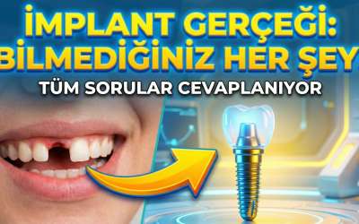 İmplant Yaptıranlar İçin Beslenme Önerileri 