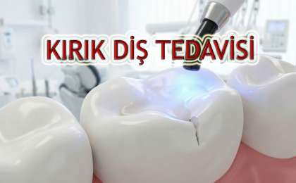 Kırık Dişe Dolgu Yapılır mı? Tedavi Yöntemleri ve Süreç