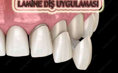 Kompozit Lamina ve Dijital Lamina Nedir?