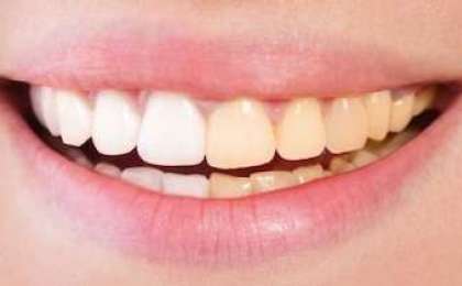 Ön dişlerde görülen renklenme problemi