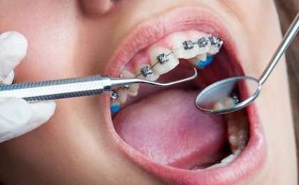 Ön dişlerde ortodonti problemleri