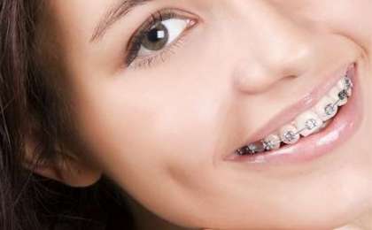 Ortodonti Tedavi Süresi