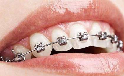 Ortodontide Tel Çeşitleri