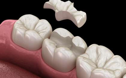 PORSELEN VE KOMPOZİT DİŞ DOLGUSU