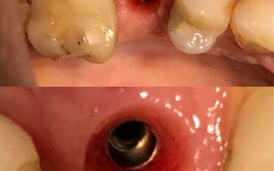 Vidalı İmplant Üstü Protez Nedir?