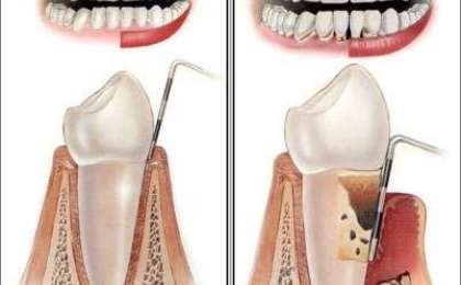 Diş Çürüğü ve Diş Eti Hastalıkları