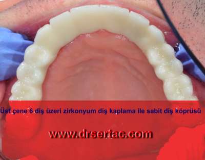 Bütün Dişlere İmplant Yaptırmak Mümkün mü?