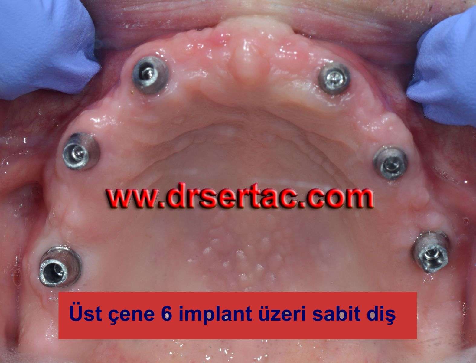 üst çene hiç diş olmayan ağızda 6 implant diş