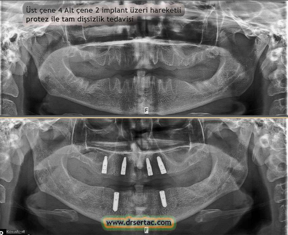 implant örnek