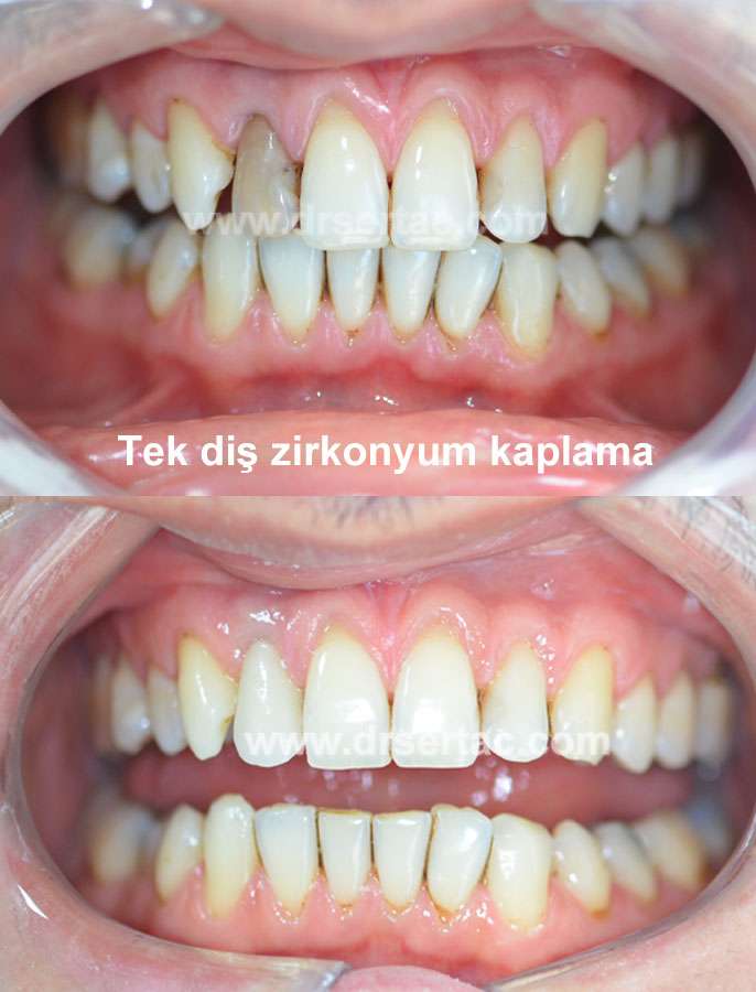 Ön diş estetiği zirkonyum kaplama ile yapılmış bir hastamız. 