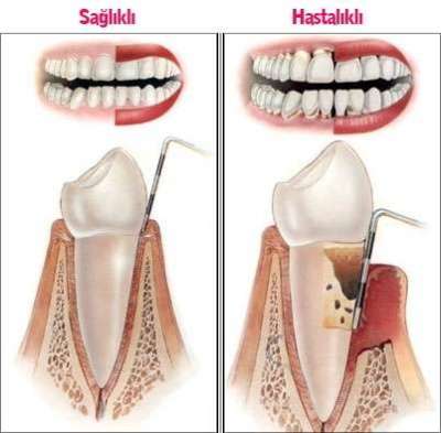 Diş Çürüğü ve Diş Eti Hastalıkları