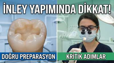 İnley ve Onley Diş Dolgusu