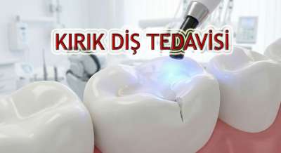 Kırık Dişe Dolgu Yapılır mı? Tedavi Yöntemleri ve Süreç