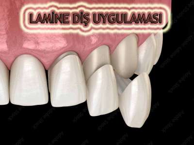 Kompozit Lamina ve Dijital Lamina Nedir?