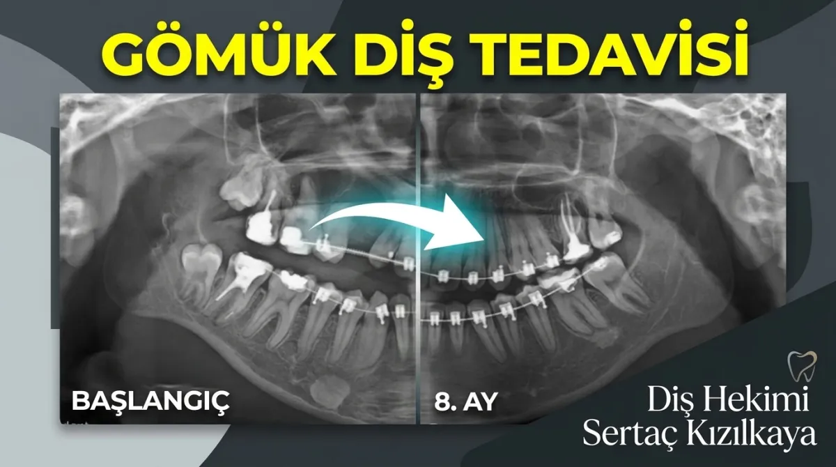 Gömük Köpek Dişi Ortodontik Tedavi ile Nasıl Sürdürülür?