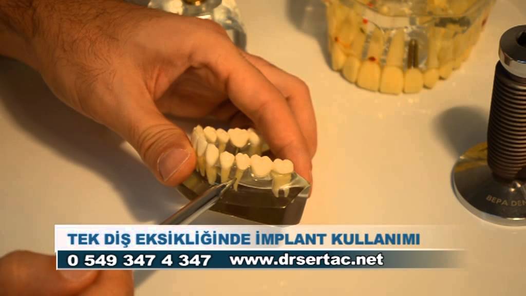 Diş eksikliğinde implant ve kaplama diş karşılaştırılması. İmplant diş avantajları İstanbul Türkiye
