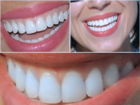 Diş eti hastalığı diş eti kanaması diş eti çekilmesi nedir? Tedavisi nasıl olur?