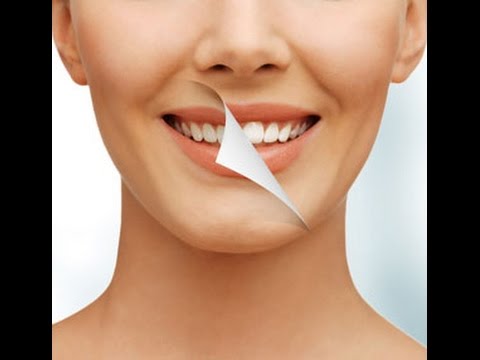 Estetik Laminate veneer diş nedir?Porselen Lamina diş kaplama avantajları nelerdir?