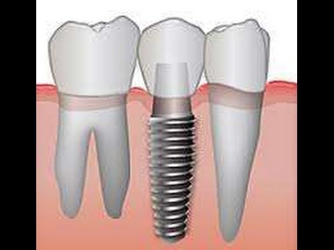 İmplant diş nasıl uzun ömrlü olabilir? En iyi implant markaları İstanbul Türkiye