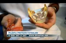 İmplant | İmplant diş nedir, ne zaman yapılır video